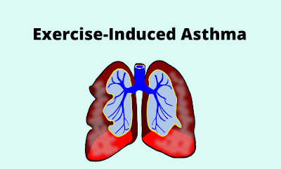 What Is Exercise-Induced Asthma?