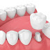 Phục hình răng bằng cầu răng sứ được bao lâu?