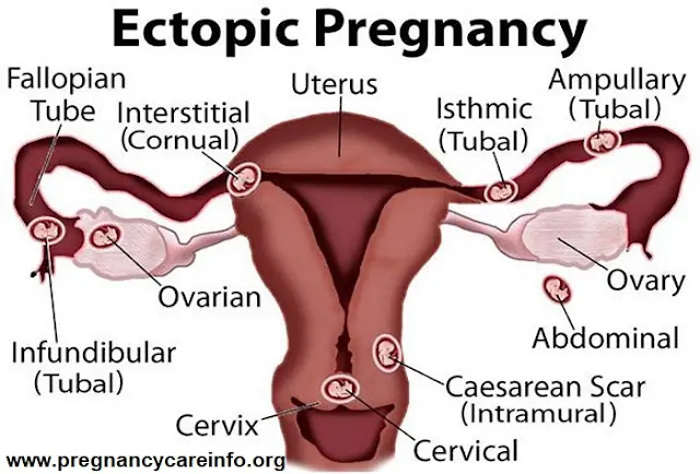 All You Need To Know About Ectopic Pregnancy