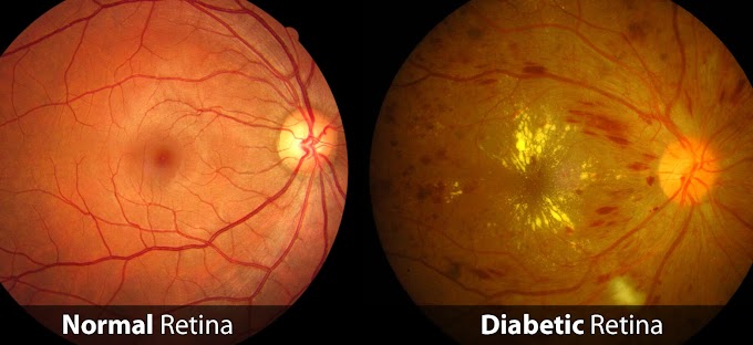 Diabetic Retinopathy Treatment Market Business Opportunities, Sales Revenue, Statistics and Analysis of COVID-19 | 2027