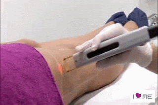 depilacion laser en las piernas