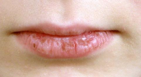 5 Ways to Overcome Dry Lips Broken