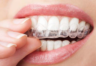Đặc điểm nổi bật nhất của niềng răng không mắc cài eCligner