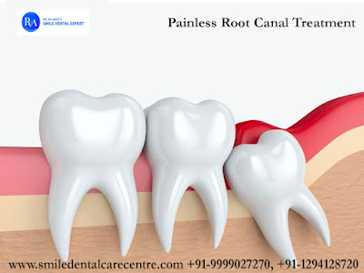Painless Root Canal Treatment in India