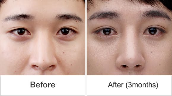 짱이뻐! - Korean Rhinoplasty Specialized Hospital, Strong and Soft at The Same Time