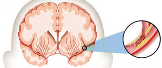 Fisiologi Penyakit Stroke, Cara Mengobati Gejala Penyakit Stroke, Bahaya Penyakit Stroke Ringan, Pathway Penyakit Stroke Pdf, Resep Obat Herbal Stroke, Pengobatan Stroke Terbaru, Cara Ampuh Mengobati Penyakit Stroke, Mengatasi Penyakit Stroke Ringan, Pengobatan Alami Stroke Ringan, Obat Herbal Sakit Stroke, Obat Herbal Gejala Stroke, Pengobatan Stroke Penyumbatan, Obat Stroke Mahal, Www.Obat Penyakit Stroke.Com, Makalah Tentang Penyakit Stroke Iskemik 