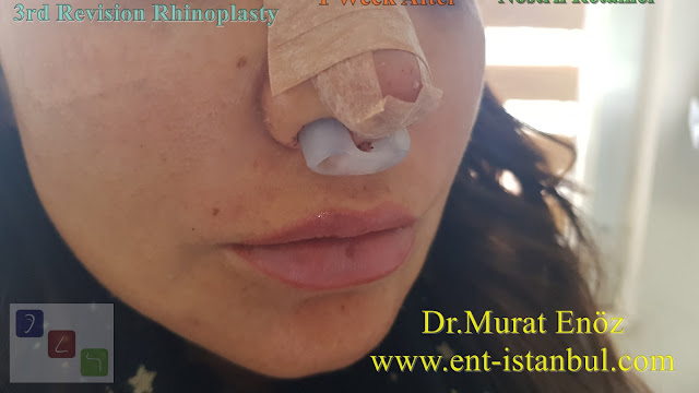 Nostril Retainer - 1 week after - 3rd Revision Rhinoplasty - Nostril Stenosis and Pollybeak Deformity - Complication Nose Surgery