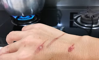 heridas de quemaduras en la mano