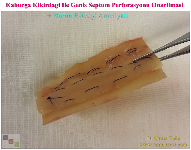 Nazal septum perforasyonu - Septum perforasyonu ameliyatı olanlar - Septum perforasyonu olanlar - Septum perforasyonu ameliyatı yapan doktorlar - Burunda delik oluşumu - Burun duvarında delik - Burun kıkırdak delinmesi tedavisi - Septum perforasyonu ameliyatı olanlar - Septum perforasyonu olanlar - Septal perforasyon tamiri - Septal buton uygulaması - Nazal septum perforasyonu tedavisi - Nazal septum perforasyonu nedenleri - Nazal septum perforasyonu belirtileri - Septum perforasyonun cerrahi onarımı - Burun delinmesinin nedenleri - Nazal septum perforasyonu tanısı - Erkek burun estetiği - Burun estetiği ameliyatı - Definition of Nasal Septal Perforation - Causes of Perforated Nasal Septum - Symptoms of Nasal Septal Perforation - Diagnosis of Nasal Septal Perforation - Surgical Treatment For Nasal Septal Perforation - Nasal Septal Perforation Repair - Surgical Repair of Nasal Septal Perforation