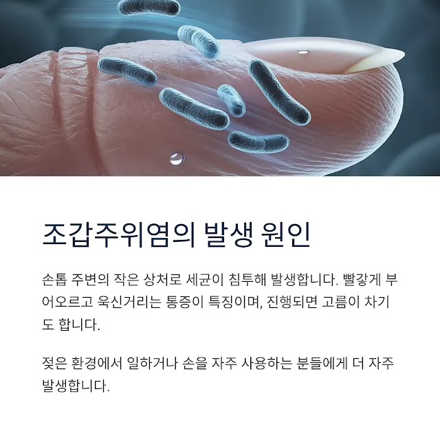 조갑주위염 원인