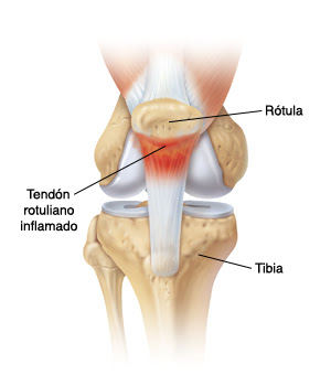 Tendinitis rotuliana