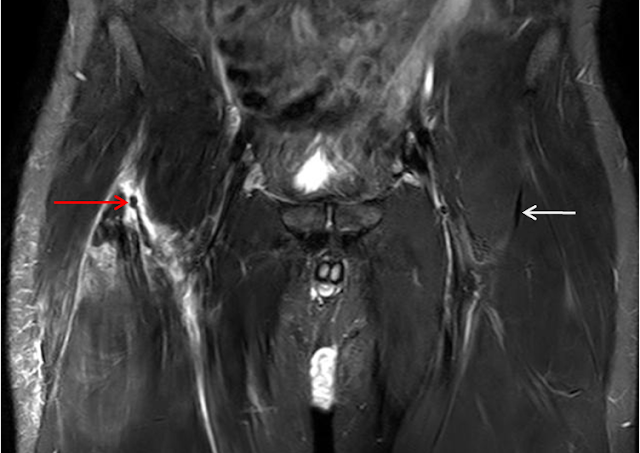 Rectus Femoris Strain Management | El Paso, TX Chiropractor