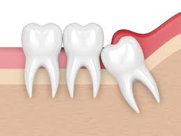 wisdom tooth extraction cost in gurgaon