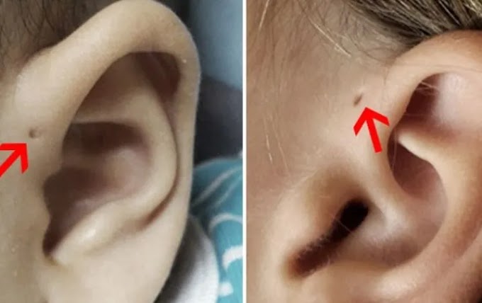 Esto es lo que significa este curioso oyuelo en la oreja.