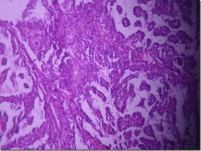 thyroid gland papillary carcinoma