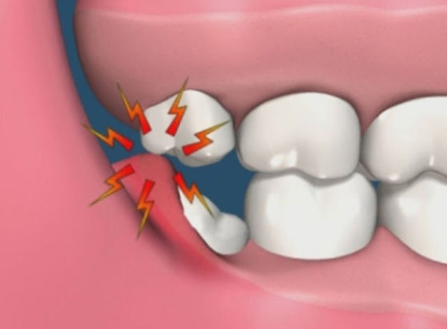 Răng khôn làm tích tụ vi khuẩn và gây viêm nha chu