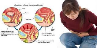 Obat Tradisional Ampuh Sakit Kencing Pada Wanita