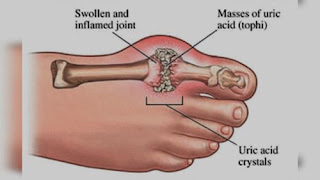 Penyebab penyakit asam urat dan cara mengatasinya, mengobati asam urat alami, cek asam urat hasilnya lo, asam urat itu sakit apa, obat herbal asam urat atau rematik, sakit di telapak kaki asam urat, cara alami untuk obat asam urat, asam urat tidak normal, asam urat penyebab dan pengobatannya, google gejala asam urat, penyakit asam urat dan obat herbal