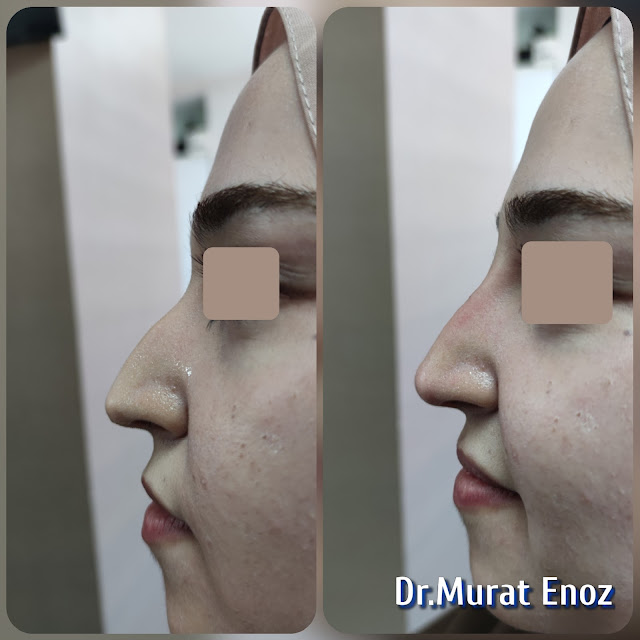 Non-Surgical Nose Job in İstanbul