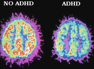 gambaran MRI ADHD