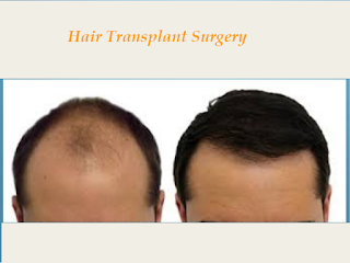 FUE hair transplant in Islamabad