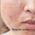 Rekomendasi Skincare Fungal Acne Safe dengan Harga Terjangkau