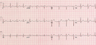 Unduh 570 Gambar Ekg Jantung Koroner  HD