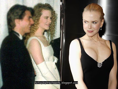 Nicole Kidman Boob job (Breast Implants or Augmentation)