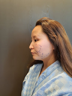 operasi plastik, operasi plastik korea, operasi hidung, operasi sedot lemak waja, hidung bengkok, hidung mancung, bedah plastik, before after, nana plastic surgery, nana hospital