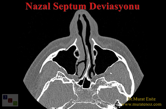 Nazal septum deviasyonu nasıl anlaşılır? - Septum deviasyonu belirtileri - Burunda kıkırdak eğriliği belirtileri - Nazal septum eğriliği belirtileri - Burunda kemik eğriliği belirtileri - Nazal septum deviasyonu nasıl anlaşılır?