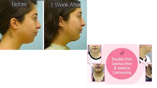 chin liposuction before and after