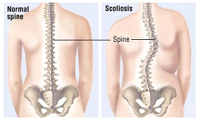 Scoliosis-In-Adult