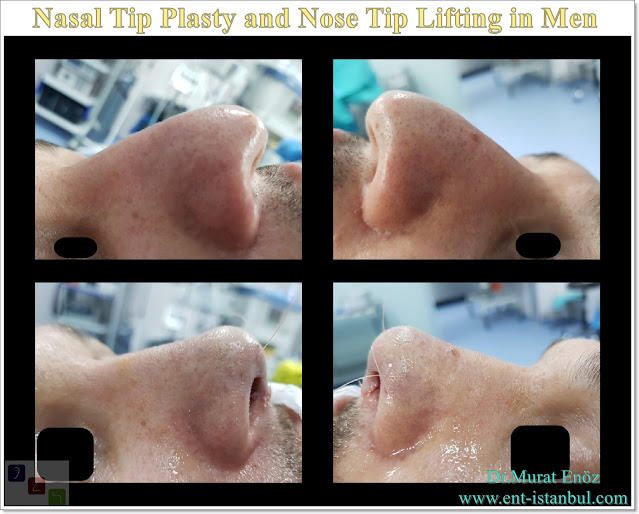 Droopy nose tip - Nasal tip plasty in men istanbul