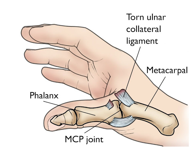 Gamekeeper's thumb