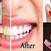 Whiten Teeth at Home in 3 Minutes SIMPLE trick