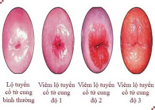 Triệu chứng viêm lộ tuyến cổ tử cung