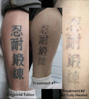 Tattoo Removal Laser