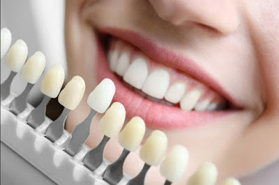 Khắc phục răng nhiễm màu tetracyclin hiệu quả 2