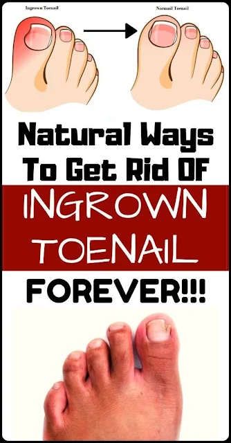 Natural Home Remedy for Ingrown Toenails