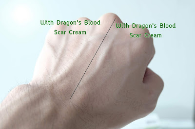 เทียบระหว่างฝั่งที่ทา Dragon's Blood Scar Cream กับฝั่งที่ไม่ได้ทา