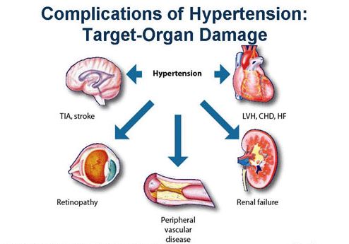 komplikasi hipertensi