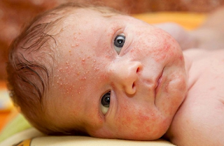 Acne in Babies, Causes and How to Overcome It