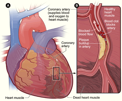 coronary artery disease