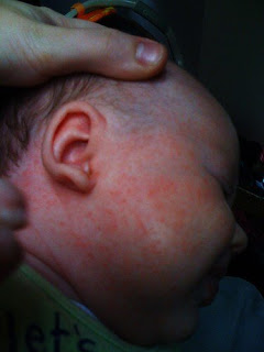 baby acne or rash