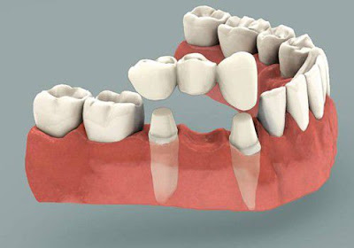 Tìm hiểu cầu răng sứ là gì?