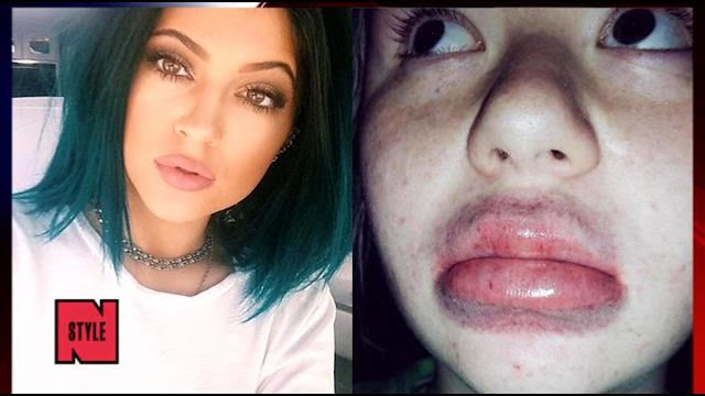 Kylie lip challenge fail