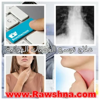 ما هو علاج توسع القصبات الهوائية ؟