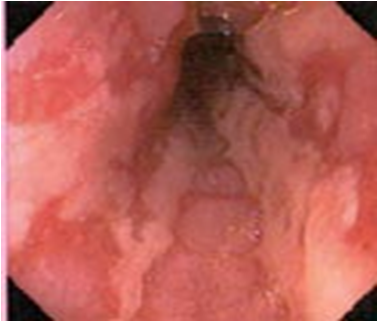 Medicine: Possible factors for lower prevalence of GERD in Asia