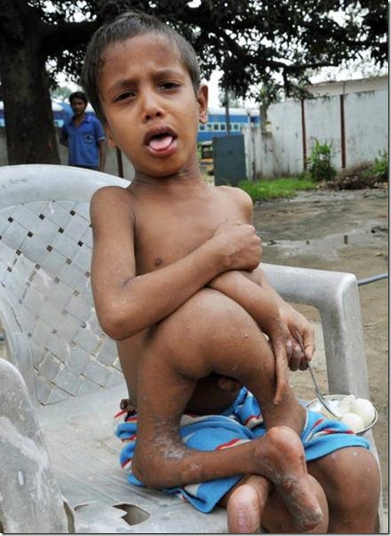 India´s octo-limbo kid wants help