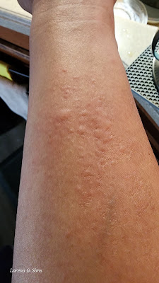 Itchy bumps, skin redness, allergic reaction to cold